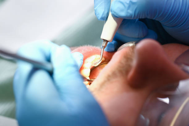 Best Emergency Wisdom Teeth Removal in Brewerton, NY