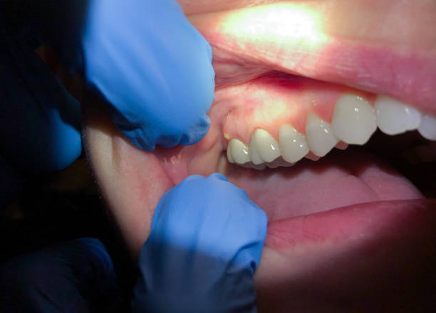 Best Emergency Broken Tooth Repair in Brewerton, NY